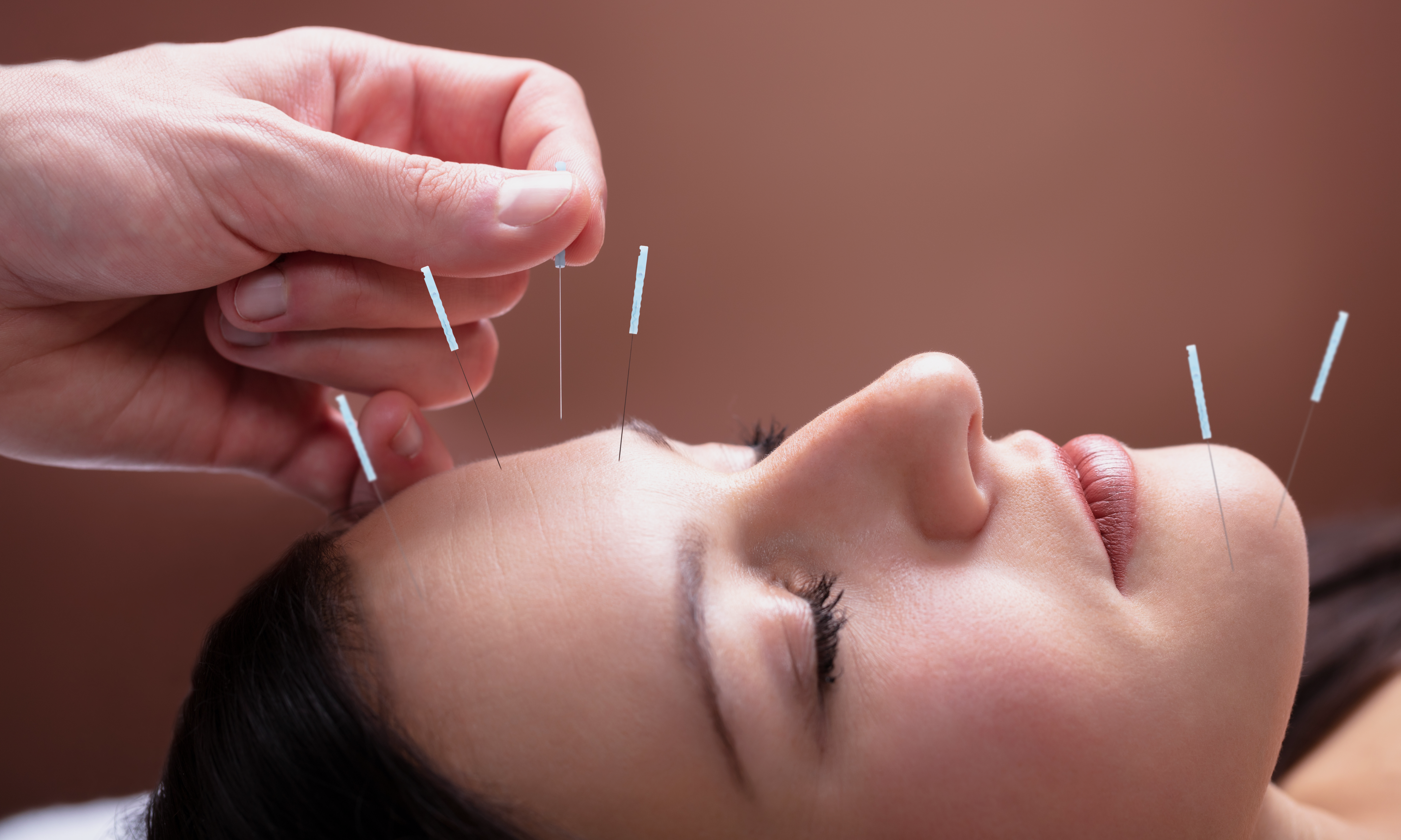 Multiple Precisely Placed Acupuncture Needles on Beautiful Face