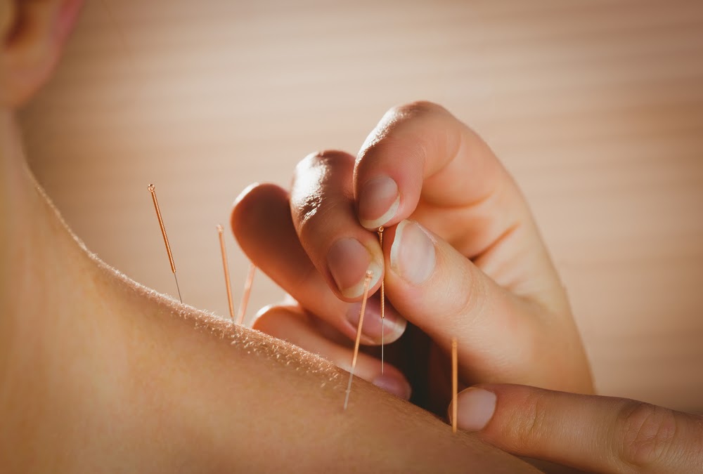 Dry Needling