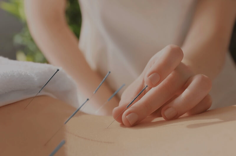 Acupuncture - Improved Health - Needles - Back Treatment