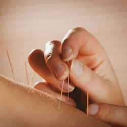 best dry needling acupuncture